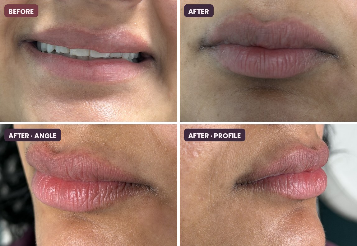 Volbella XC Lip Filler Touch-Up before and after at Serene Med Spa Barboursville