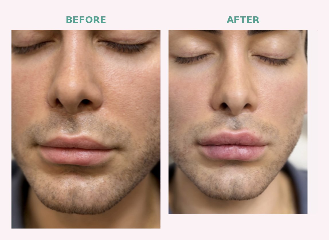 Before and after lip filler results at Serene Med Spa Barboursville