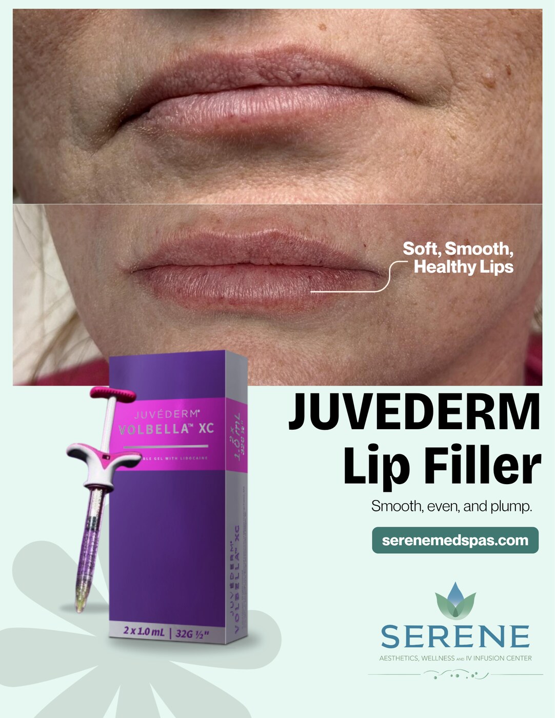 Before and after lip filler at Serene Med Spa Barboursville