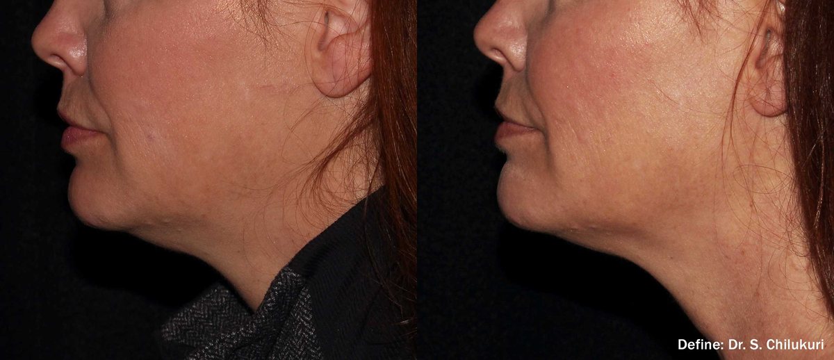 Before and after InMode Define of the jawline and neck, left side