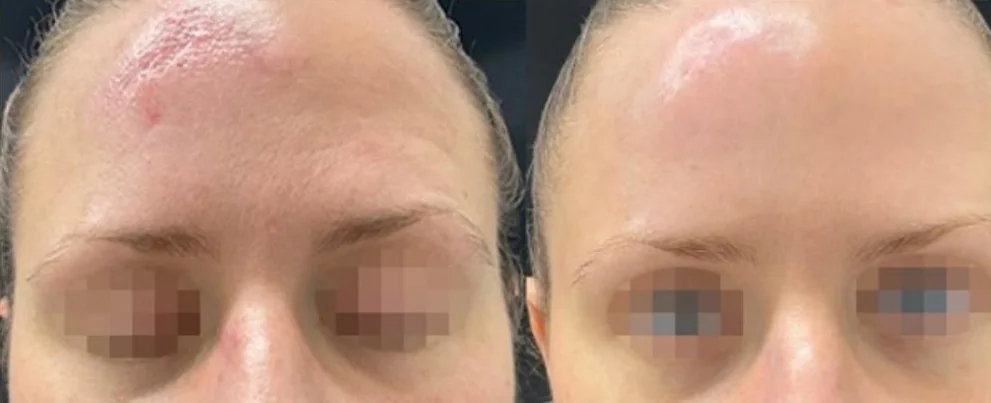 Alma Hybrid before and after: forehead redness and scarring, after 2 treatments