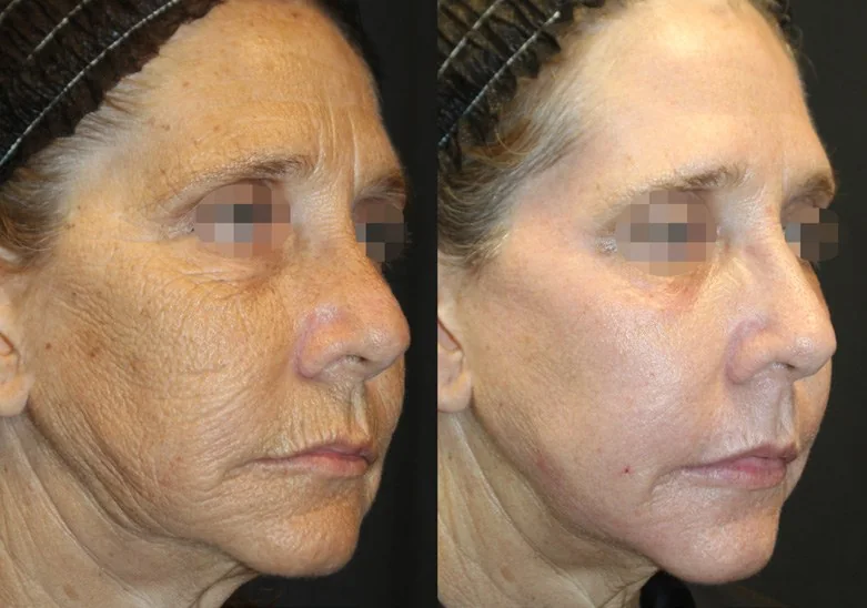 Alma Hybrid before and after: wrinkles and crepey skin, after 1 treatment