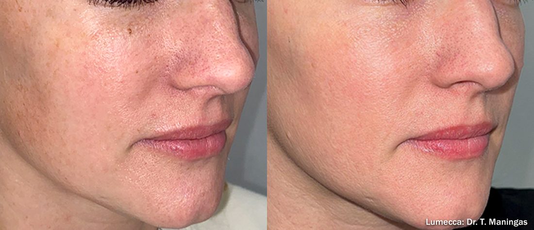 Before and after Lumecca Peak IPL of the cheek