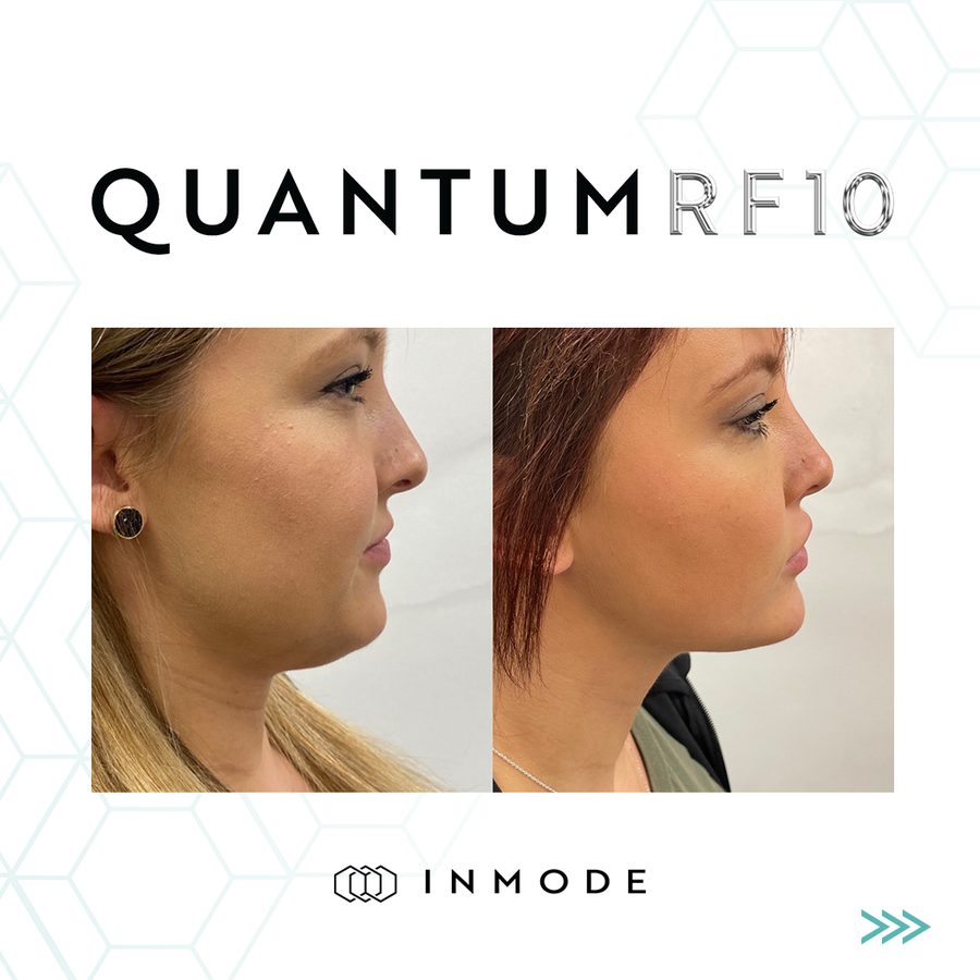 Before and after QuantumRF 10 of the jawline and under-chin, side view