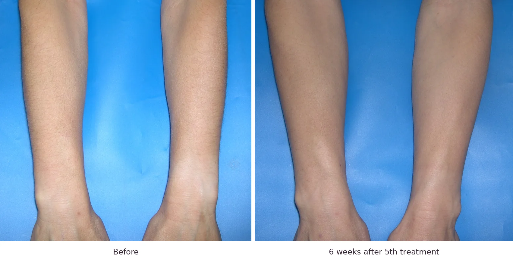 Soprano laser hair removal before and after: fine vellus arm hair, 6 weeks after 5th treatment