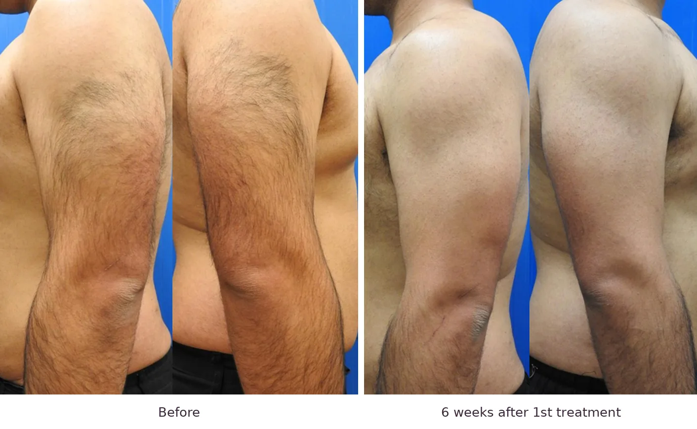 Soprano laser hair removal before and after: back, 6 weeks after 1st treatment