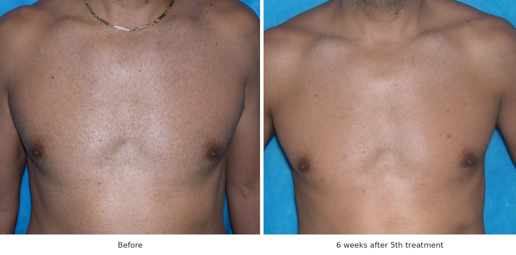 Soprano laser hair removal before and after: chest, 6 weeks after 5th treatment