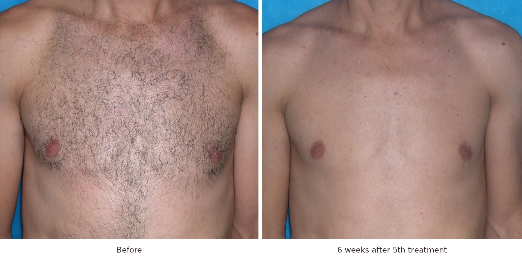 Soprano laser hair removal before and after: dense chest hair, 6 weeks after 5th treatment