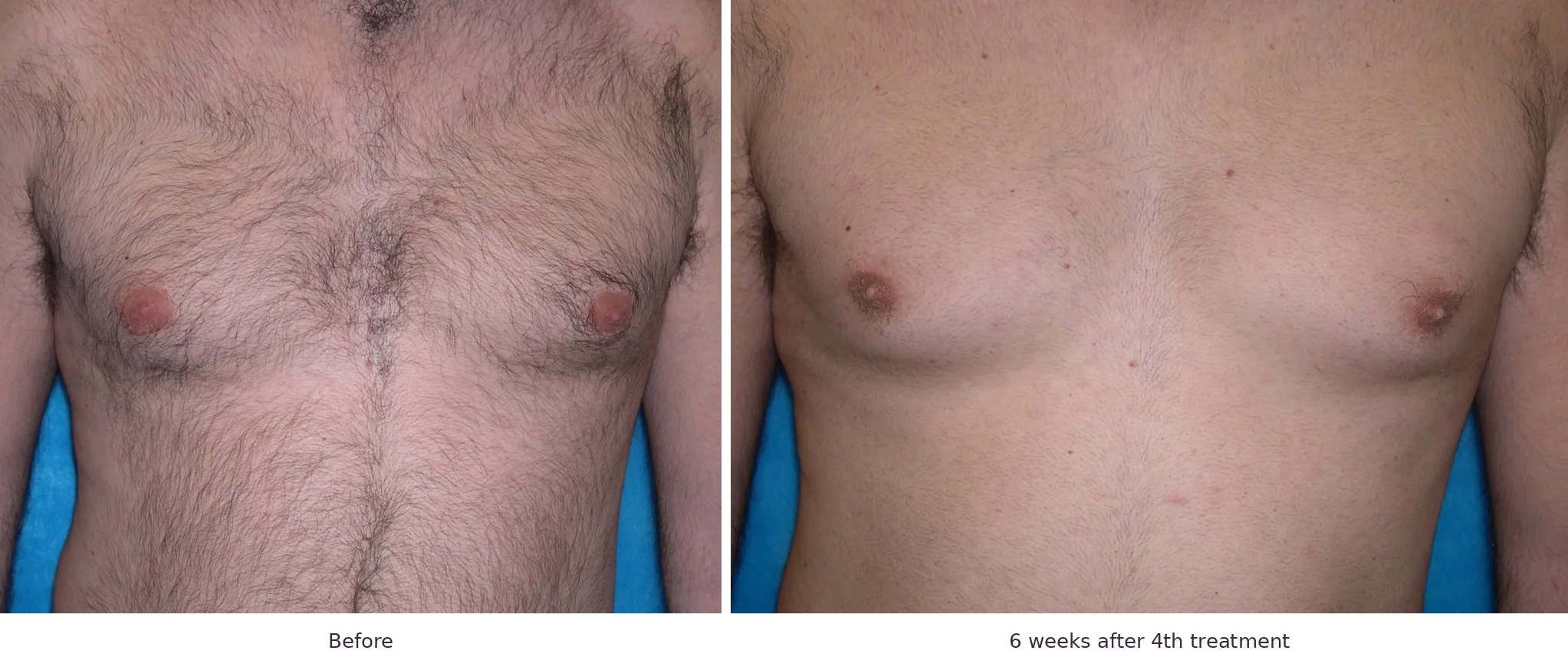 Soprano laser hair removal before and after: chest, 6 weeks after 4th treatment