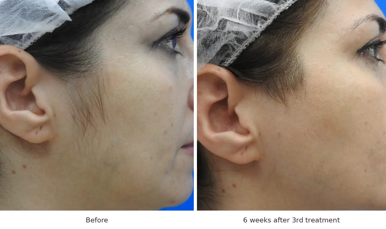 Soprano laser hair removal before and after: facial hair, 6 weeks after 3rd treatment
