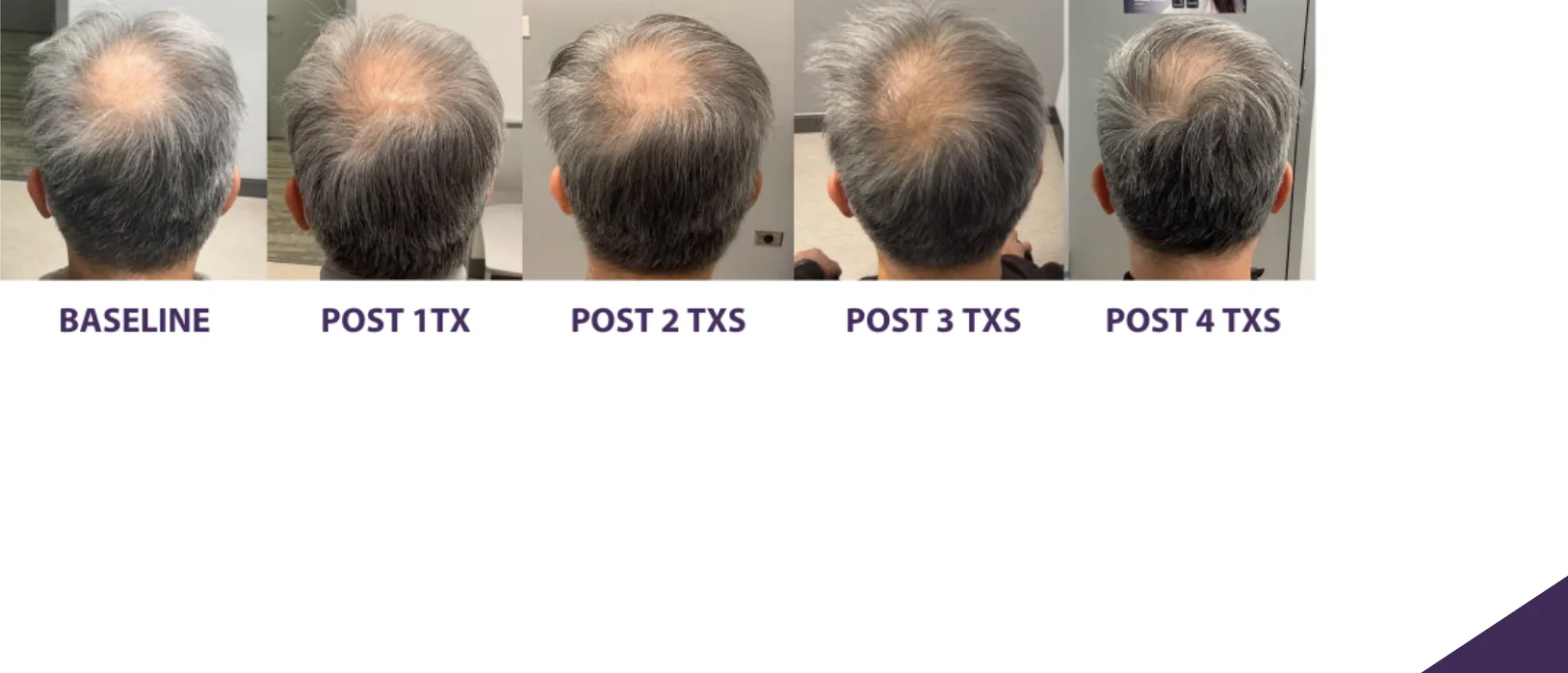 Alma TED hair restoration progression: baseline through 4 treatments