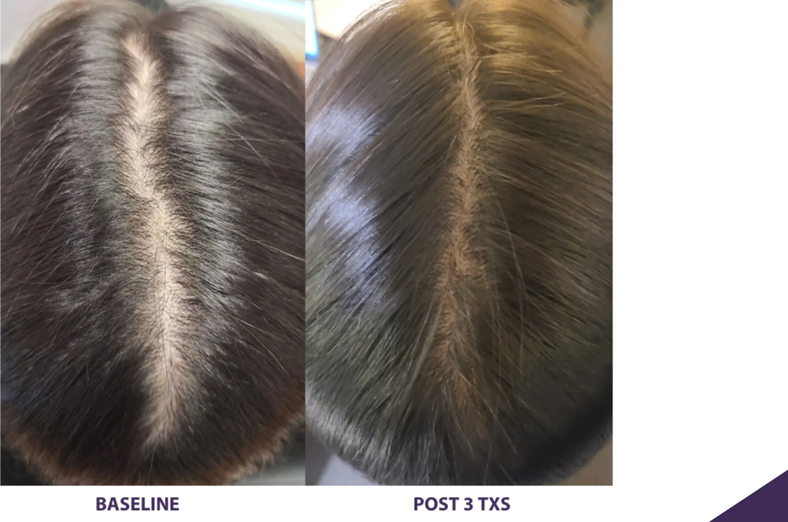 Alma TED hair restoration before and after: widening part, after 3 treatments