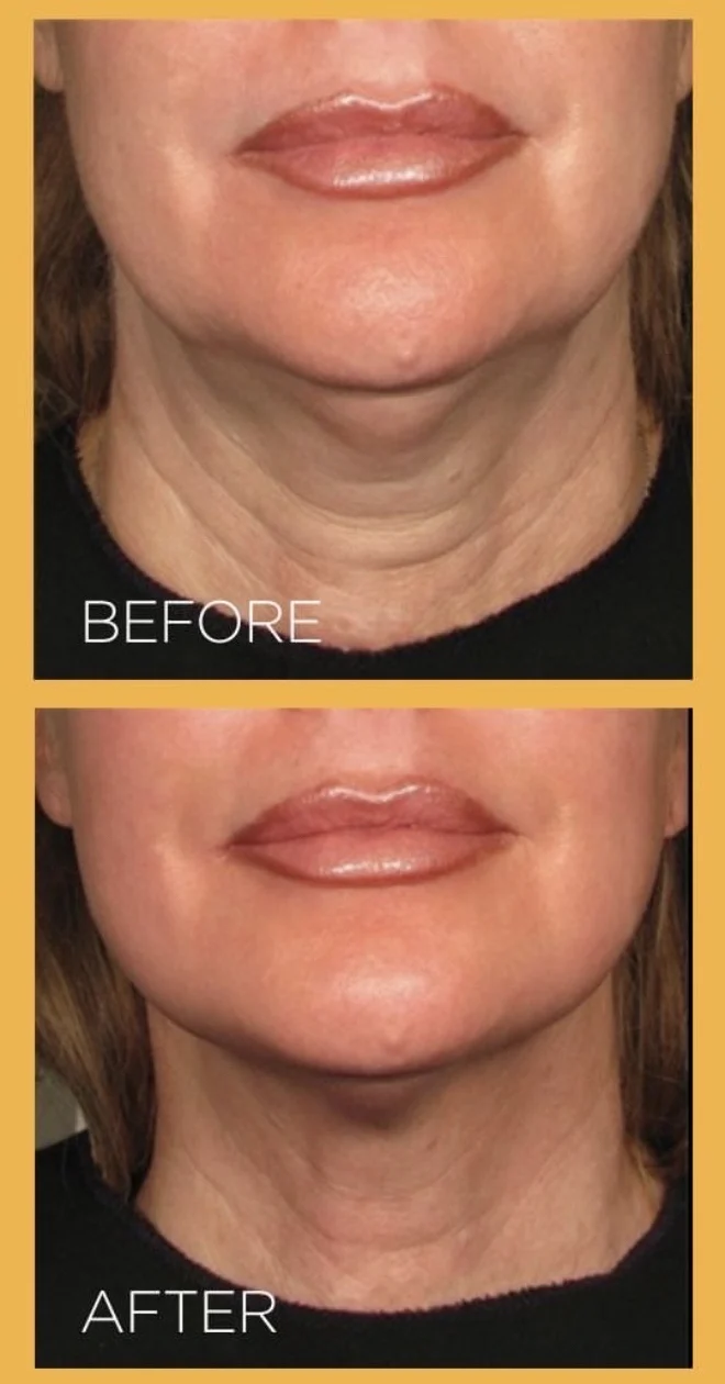 Ultherapy before and after: firmer chin and neck with smoother neck lines