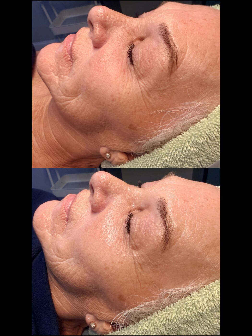 Before and after dermal filler at Serene Med Spa Hudson