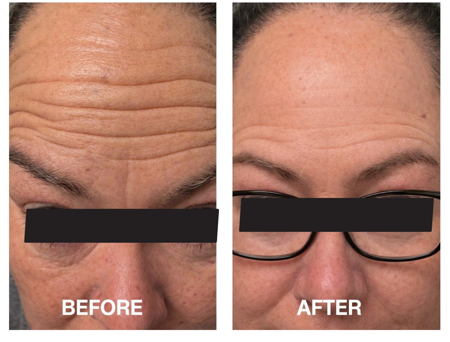 Before and after wrinkle-relaxer treatment at Serene Med Spa Hudson