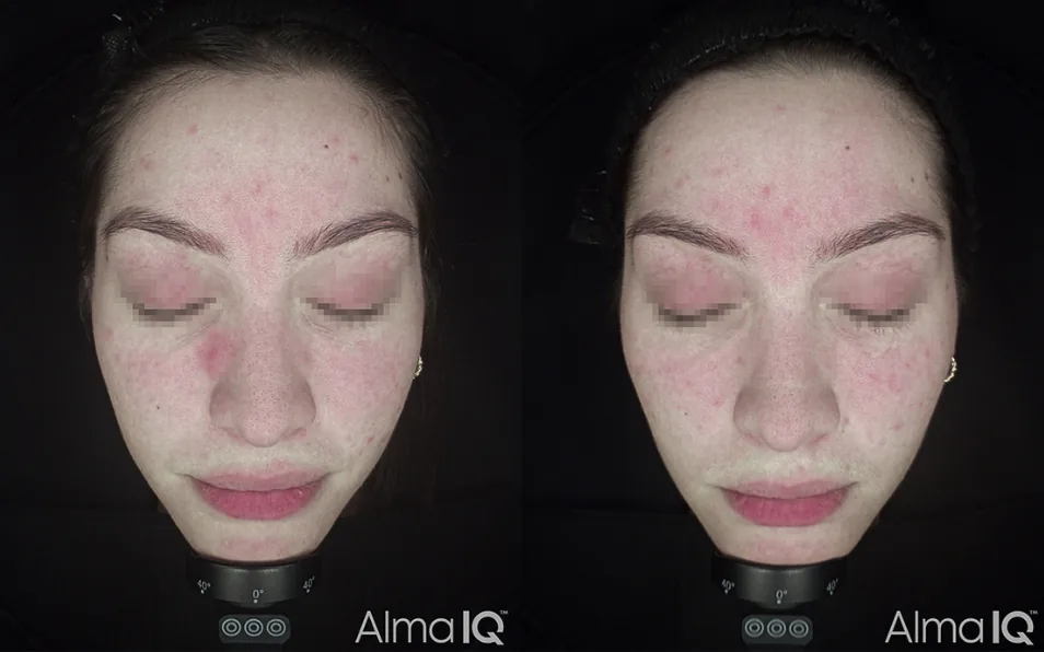 Harmony Bio-Boost before and after, vascularity view, one month after one treatment