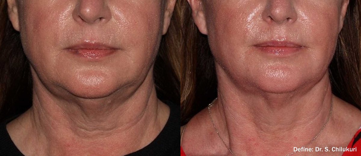 Before and after InMode Define of the jawline and neck, front view