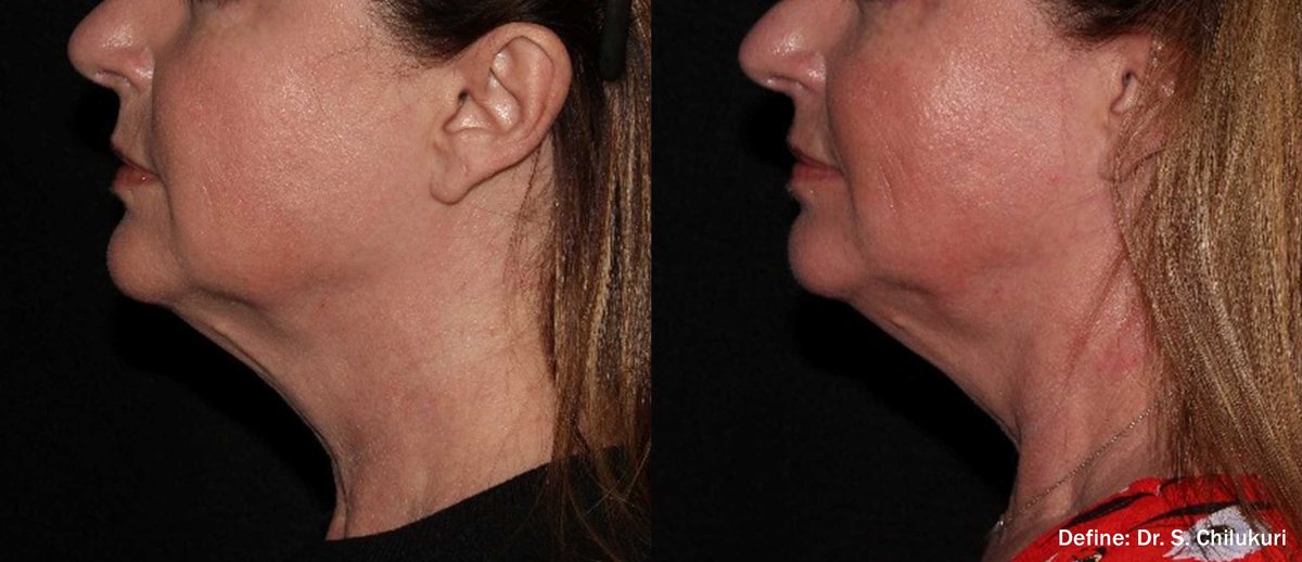 Before and after InMode Define of the under-chin and jawline, side view