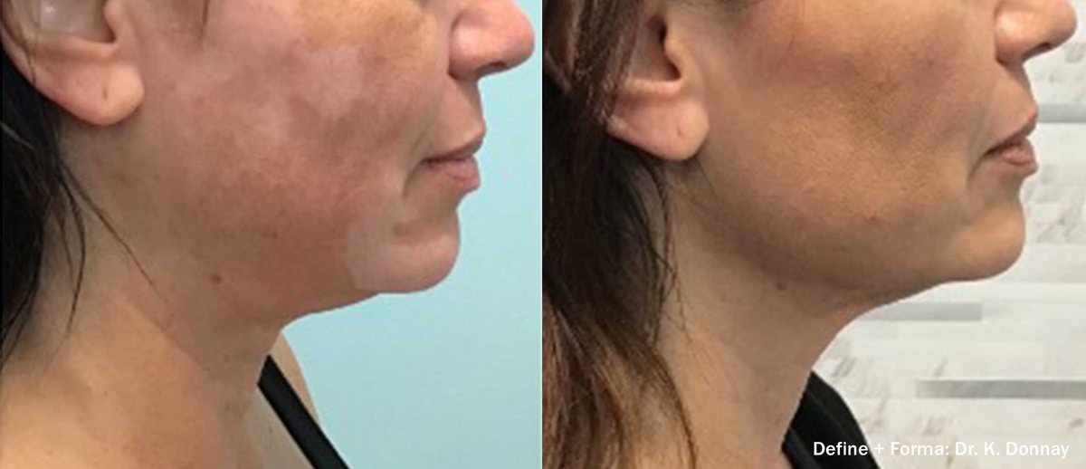 Before and after InMode Define with Forma of the jawline and under-chin