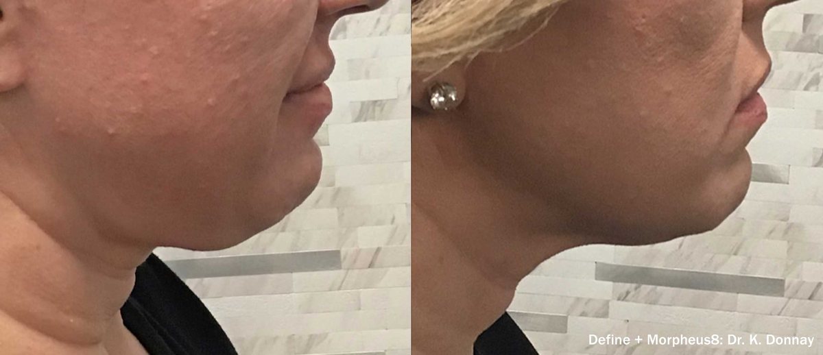 Before and after InMode Define with Morpheus8 of the lower face, right side