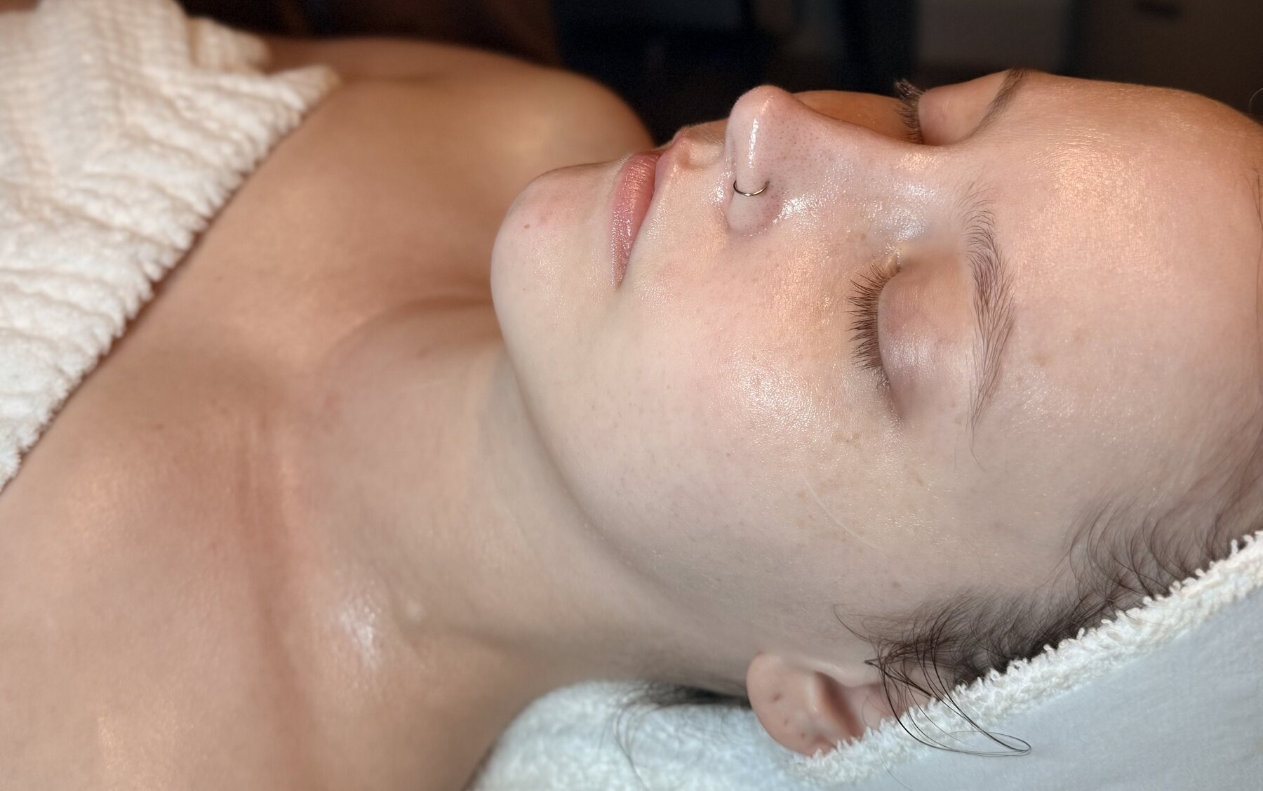 Microneedling with PRP at Serene Med Spa, Hudson OH