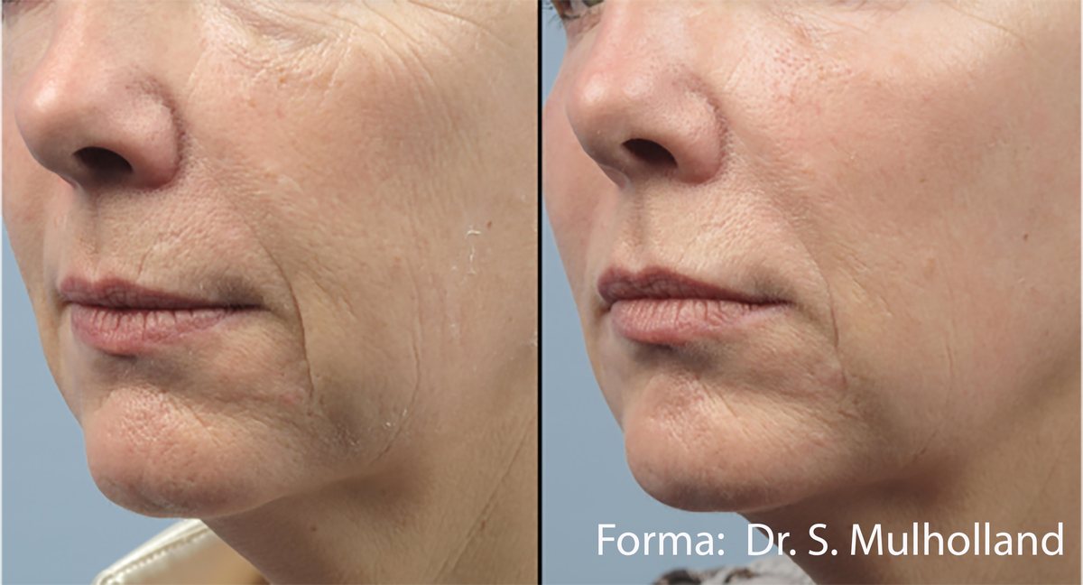 Before and after Forma radiofrequency of the lower face