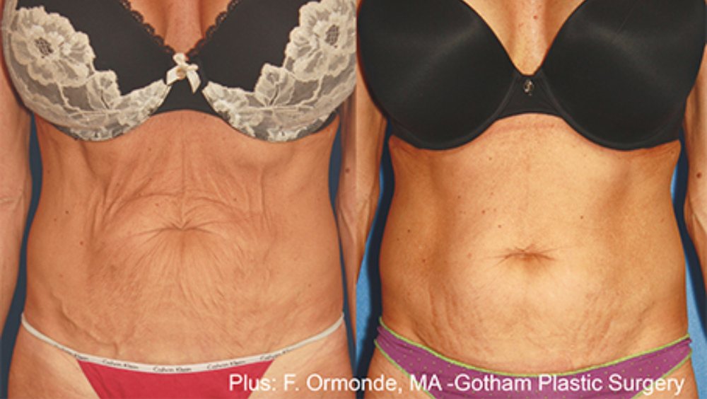 Before and after Forma Plus radiofrequency of the abdomen