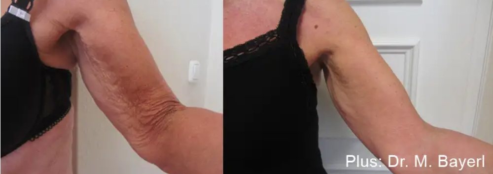 Before and after Forma Plus radiofrequency of the upper arm