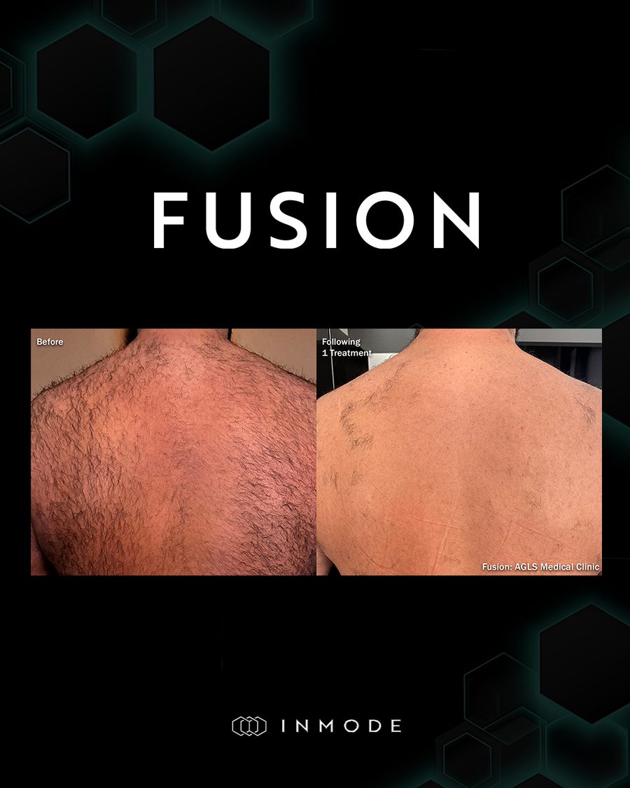 Before and after Fusion laser hair removal on the back