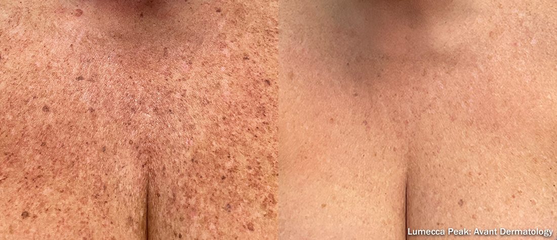 Before and after Lumecca Peak IPL of the chest