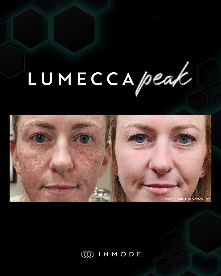 Before and after Lumecca Peak IPL of the face, front view