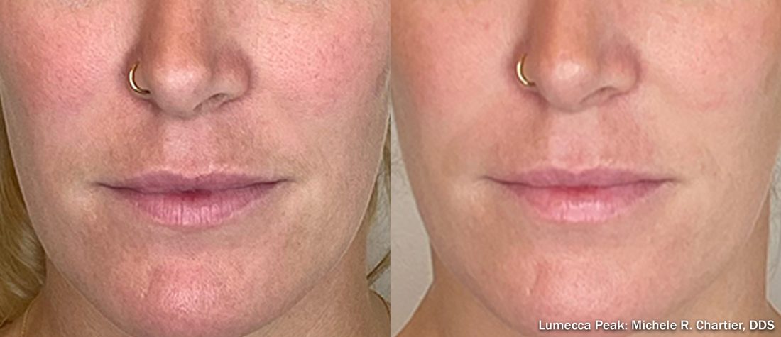 Before and after Lumecca Peak IPL of the face