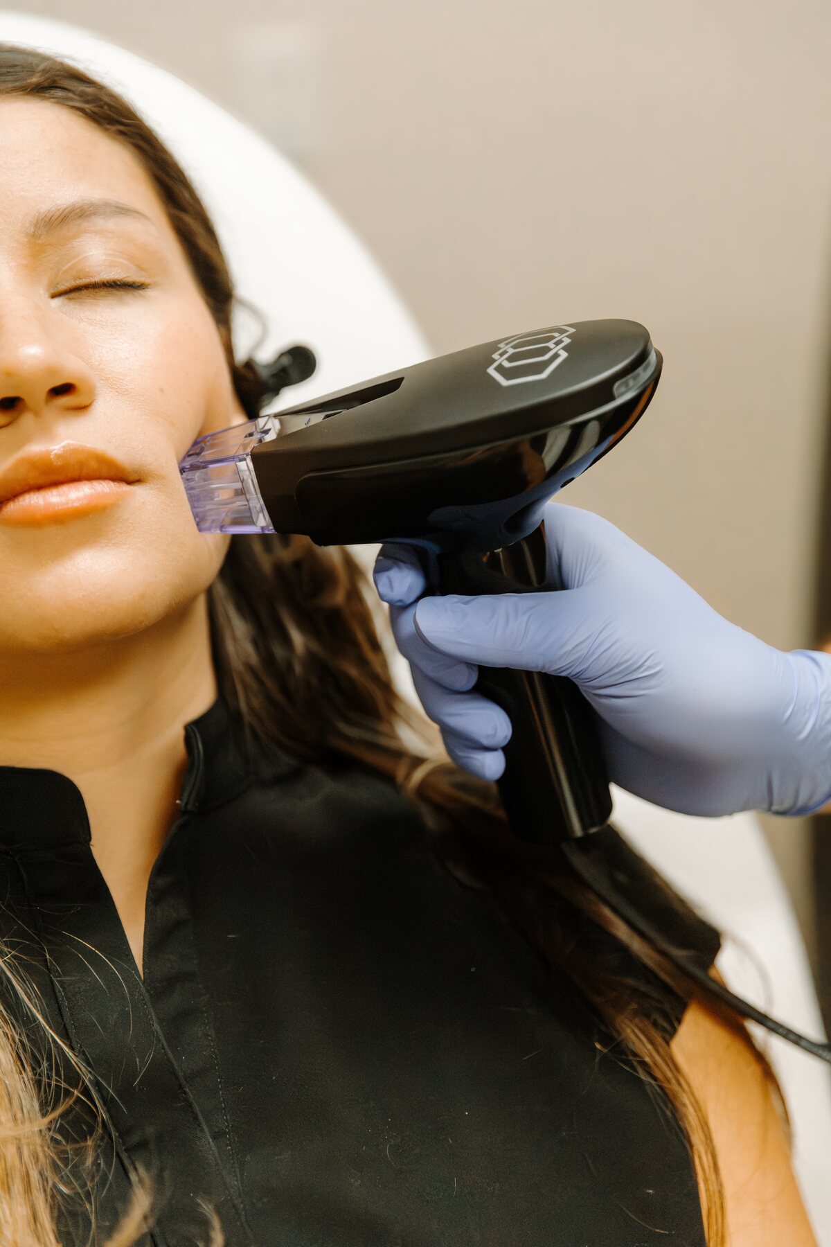 Morpheus8 microneedling in Hudson