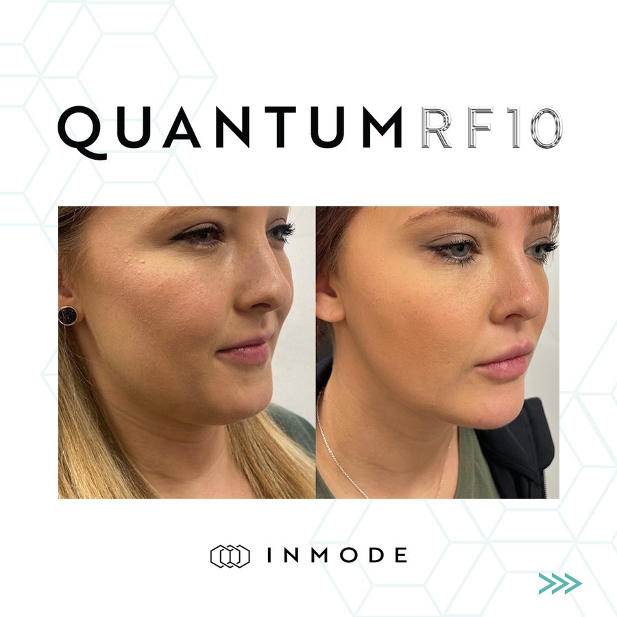 Before and after QuantumRF 10 of the jawline and under-chin, angled view