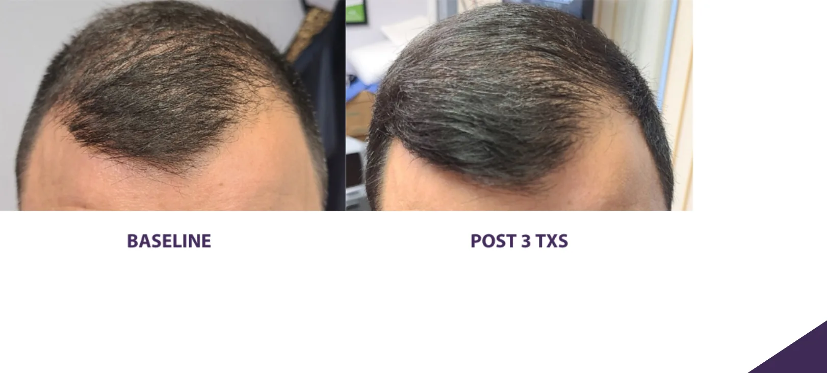 Alma TED hair restoration before and after: receding hairline, after 3 treatments