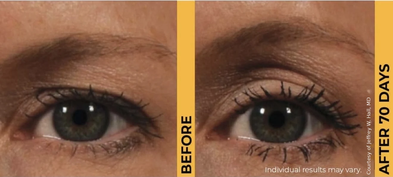 Ultherapy PRIME before and after: lifted brow and more open upper eyelid, 70 days after treatment