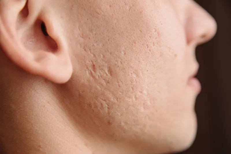 Acne & scarring