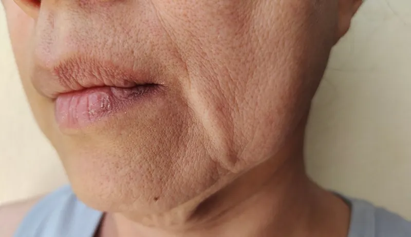 Volume loss & contour
