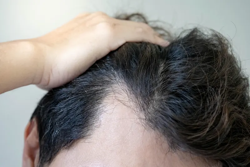 Thinning hair