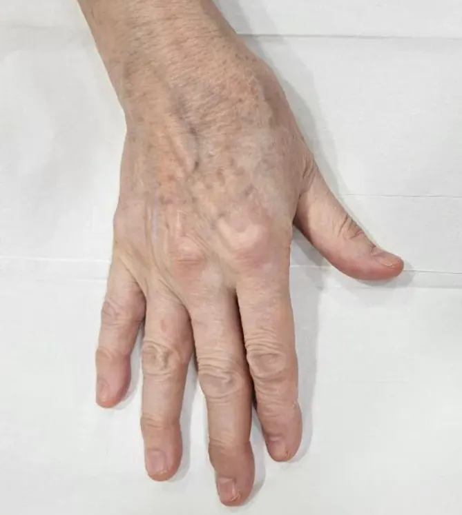 Before and after results of hand filler injections at Serene Med Spa