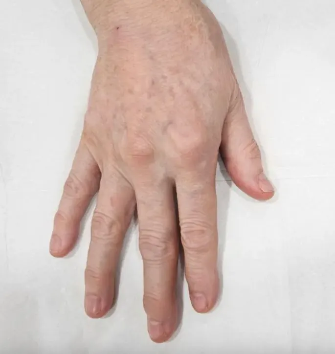 Before and after results of hand filler injections at Serene Med Spa