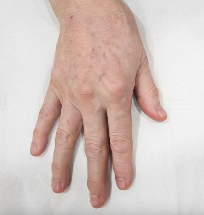 Before and after results of hand filler injections at Serene Med Spa