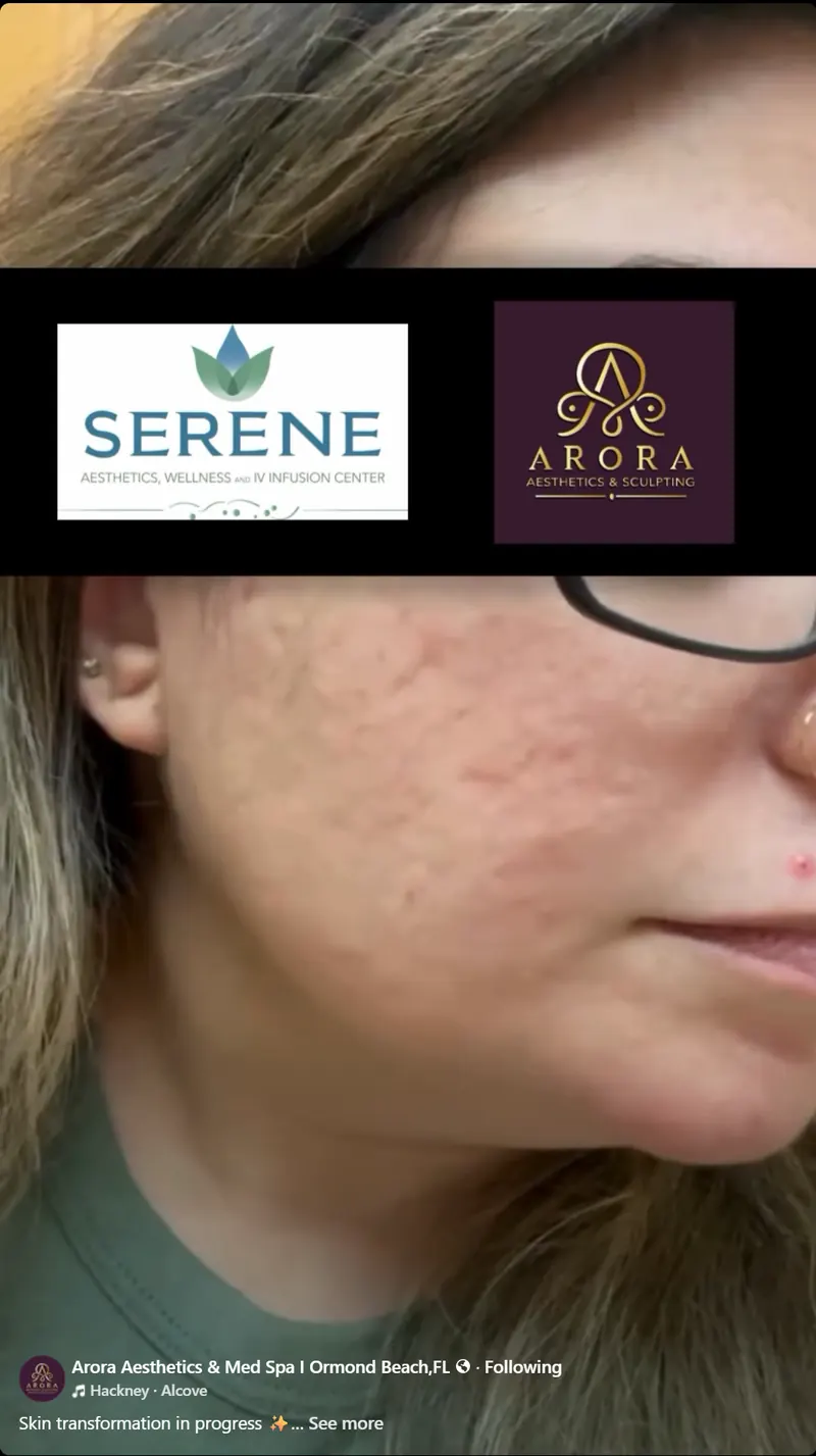 Morpheus8 RF microneedling before and after results showing skin tightening and improved texture on the face