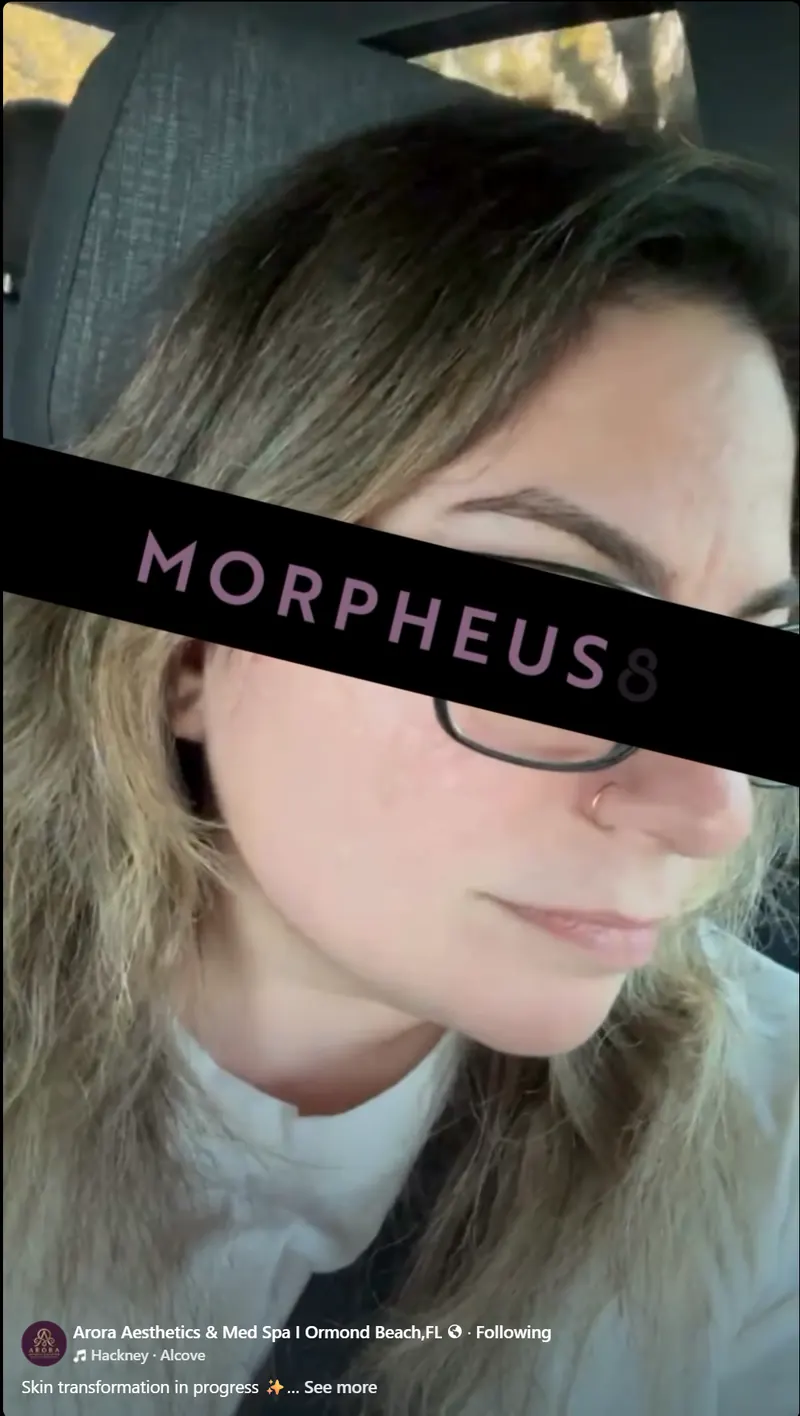 Morpheus8 RF Microneedling before and after results for facial skin tightening and texture improvement at Serene Med Spas.