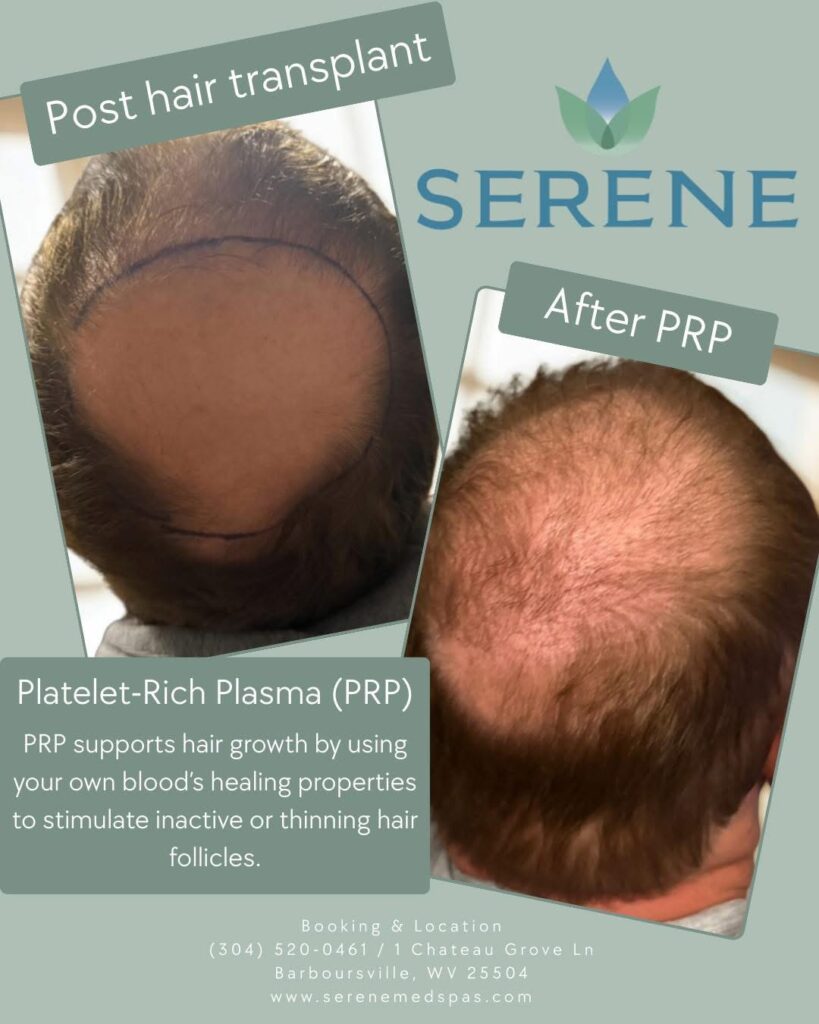 PRP hair restoration treatment for thinning hair at Serene Med Spas.