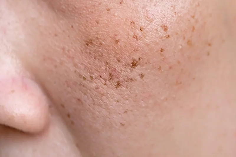 Pigmentation & sun damage