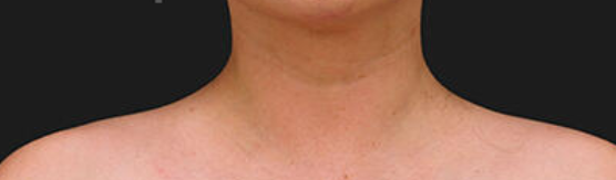 Before and after results of Botox for shoulder slimming at Serene Med Spa