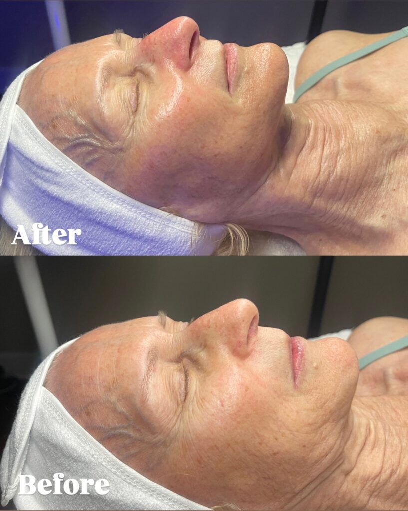 Close-up before and after comparison of a patient's face showing significant improvement in hyperpigmentation and skin clarity after a VI Peel treatment.