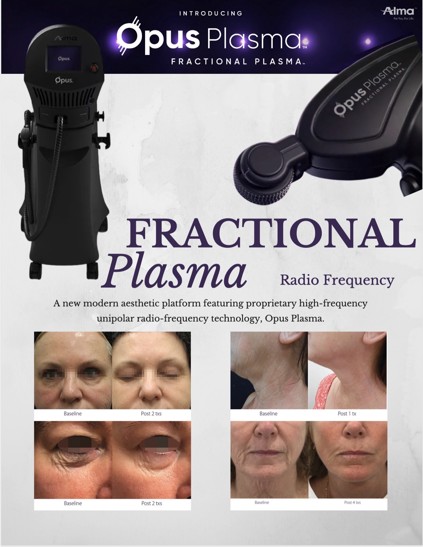 Opus Plasma Skin Resurfacing