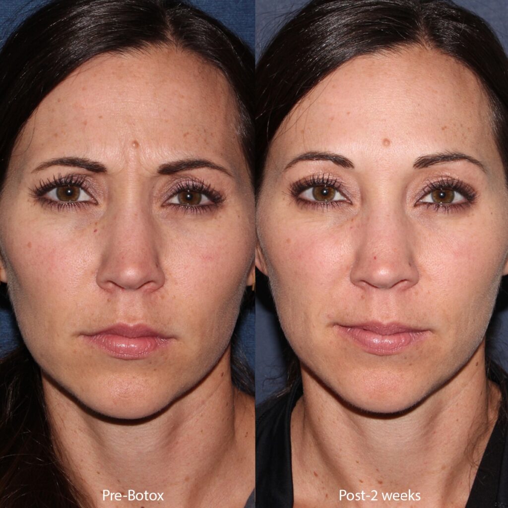 Botox for Frown Lines Benefits Risks and What to Expect